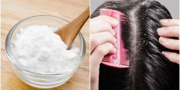 Stop Dandruff In Its Track With Easy Home Remedy