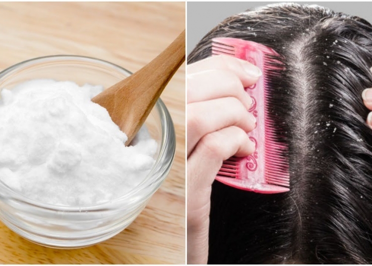 Stop Dandruff In Its Track With Easy Home Remedy