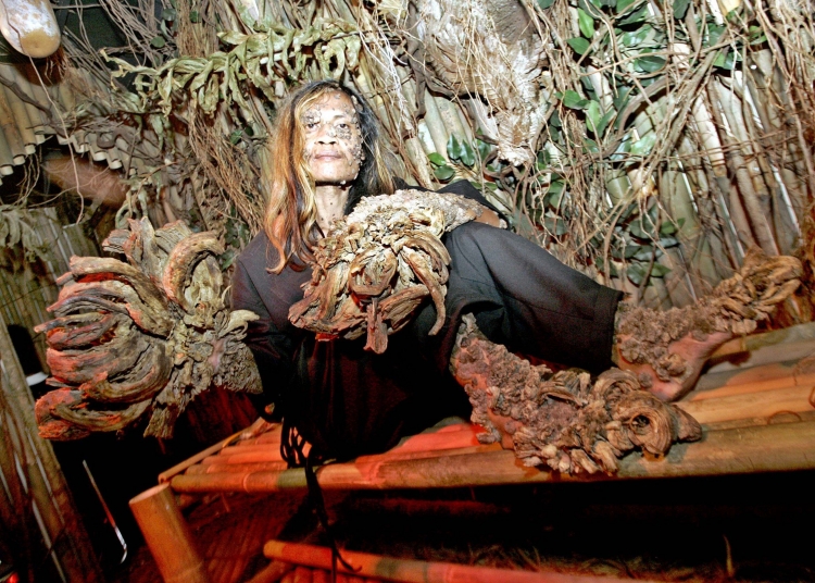 Some Rarest Diseases That You Have Never Heard