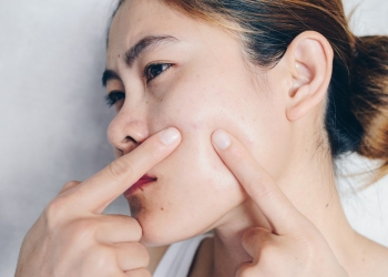 13 Powerful Home Remedies For Acne