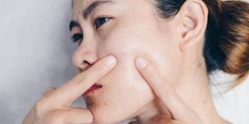 13 Powerful Home Remedies For Acne